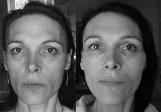 Before & After Photos FlexEffect Facialbuilding