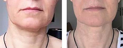 Facial Exercise: Marionette Lines - Nasolabial Folds - Facial Sag